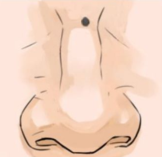 脸上哪个地方长痣需要晚婚？哪个地方长痣注意是非？