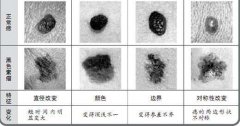 黑色素细胞痣，黑色素痣图