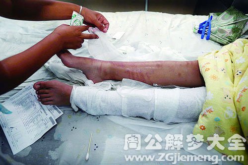 梦见海蜇蜇人