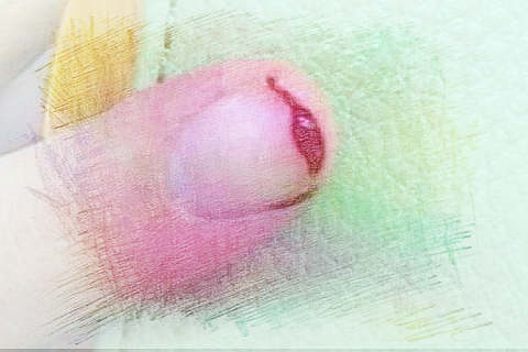指甲流血