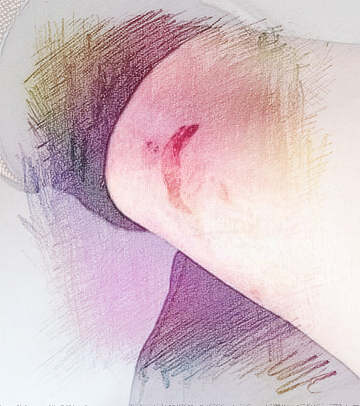  梦见腿流血了