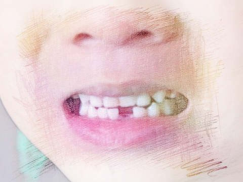 拔门牙