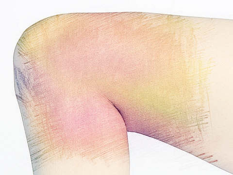 虫咬大腿