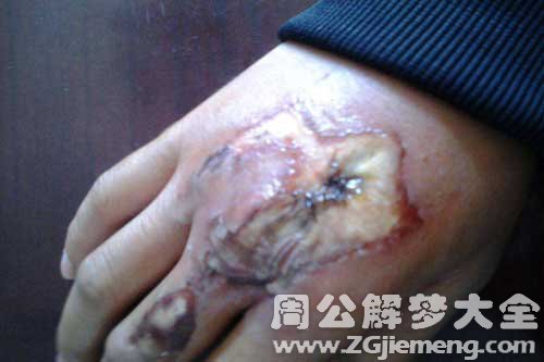 伤口结痂 伤口结痂