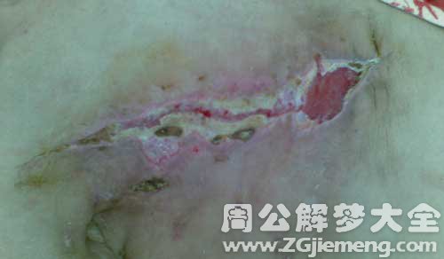 伤口裂开了 伤口裂开了