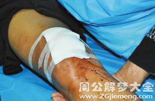 梦见膝盖破了 梦见膝盖破了