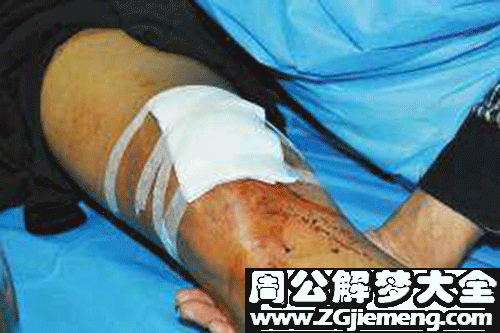 梦见大腿出血 梦见大腿出血